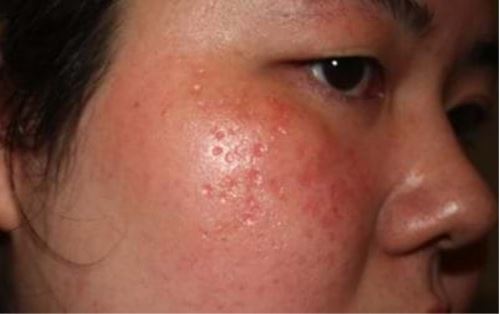 Review bắn laser trị tàn nhang của 1 bạn gái ở Hà Nội